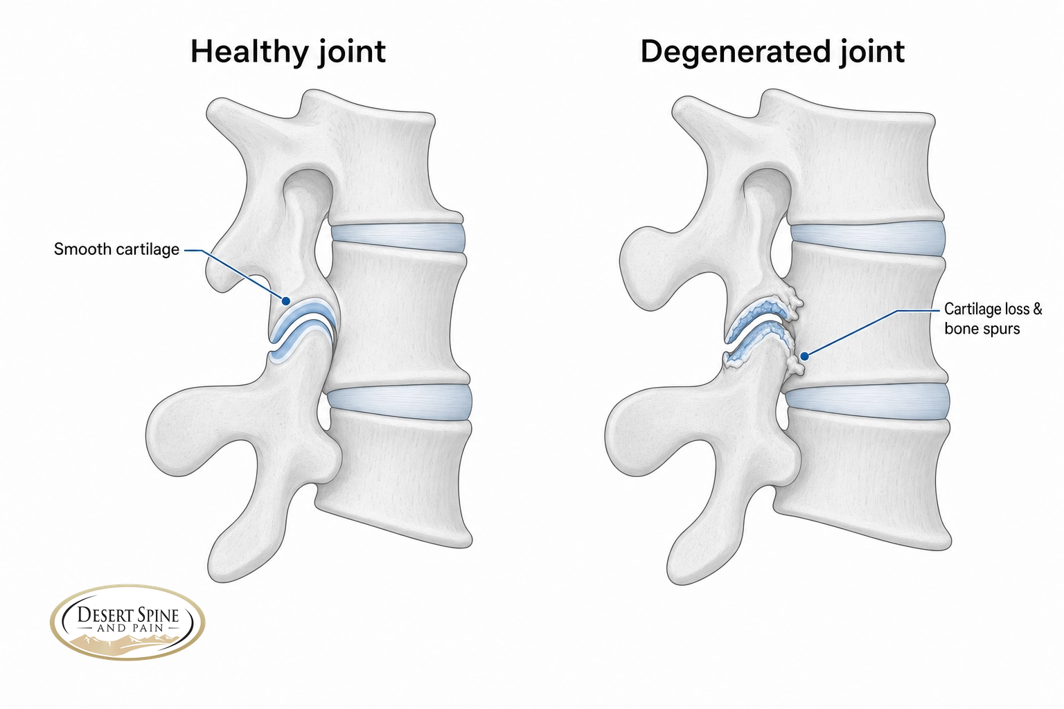 Comparison diagram of a healthy spinal facet joint with smooth cartilage versus a degenerated joint with cartilage loss and bone spurs