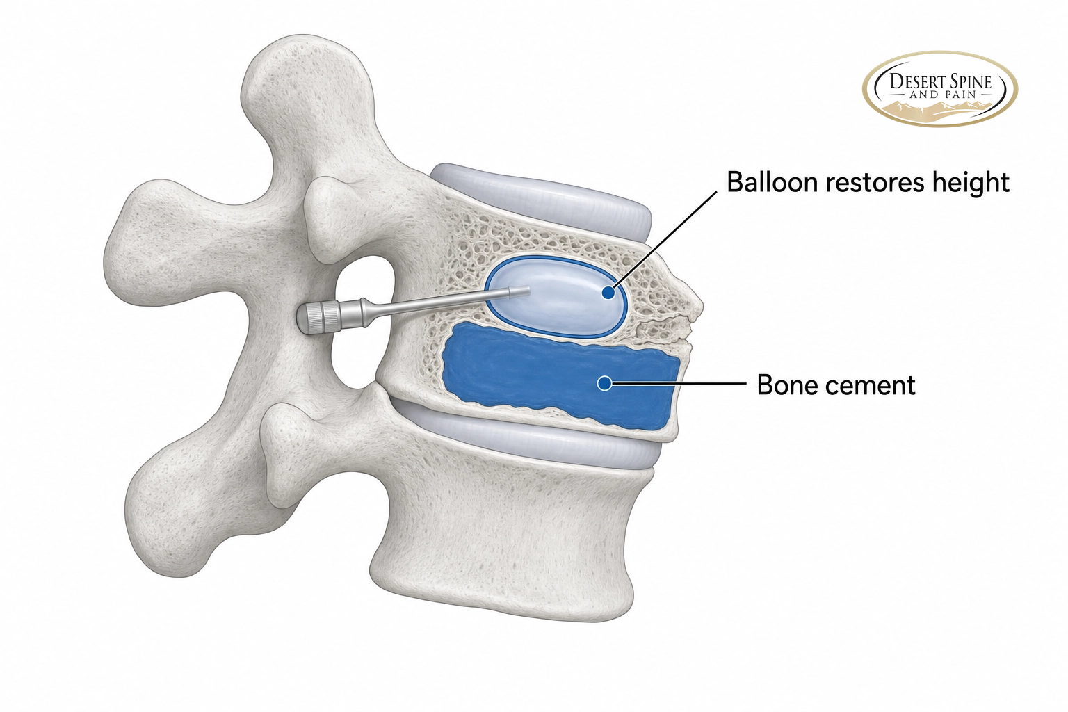 Diagram of kyphoplasty: a balloon restores vertebral height and bone cement stabilizes the fracture