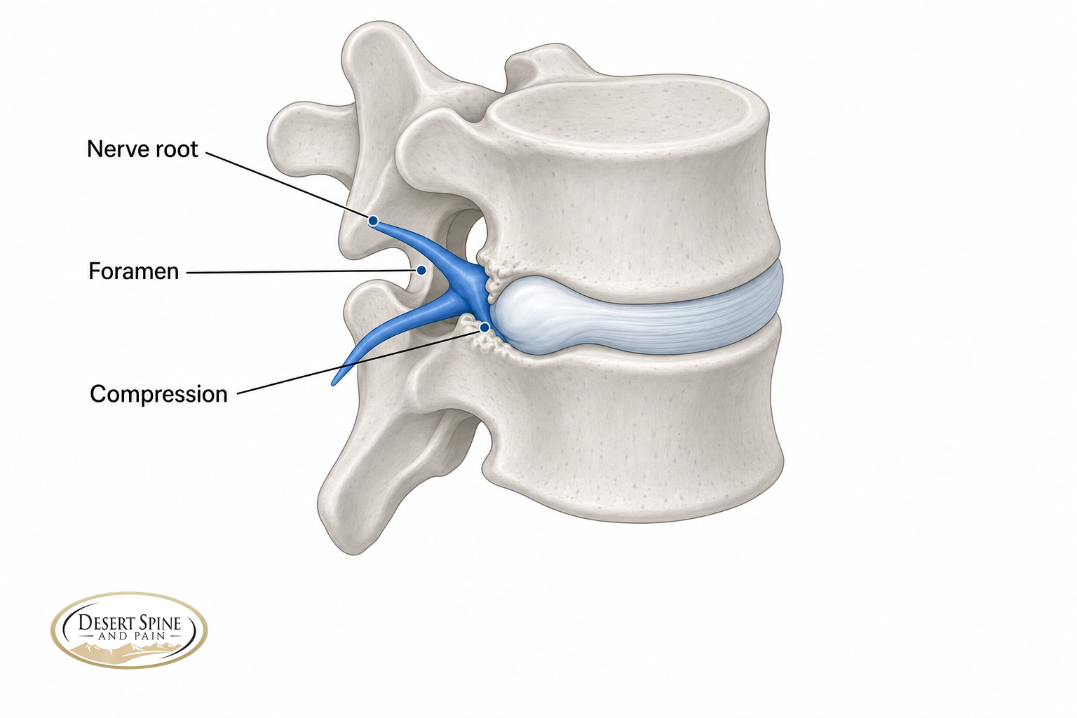 Diagram of a spinal nerve root exiting the foramen and being compressed by a disc and bone spur