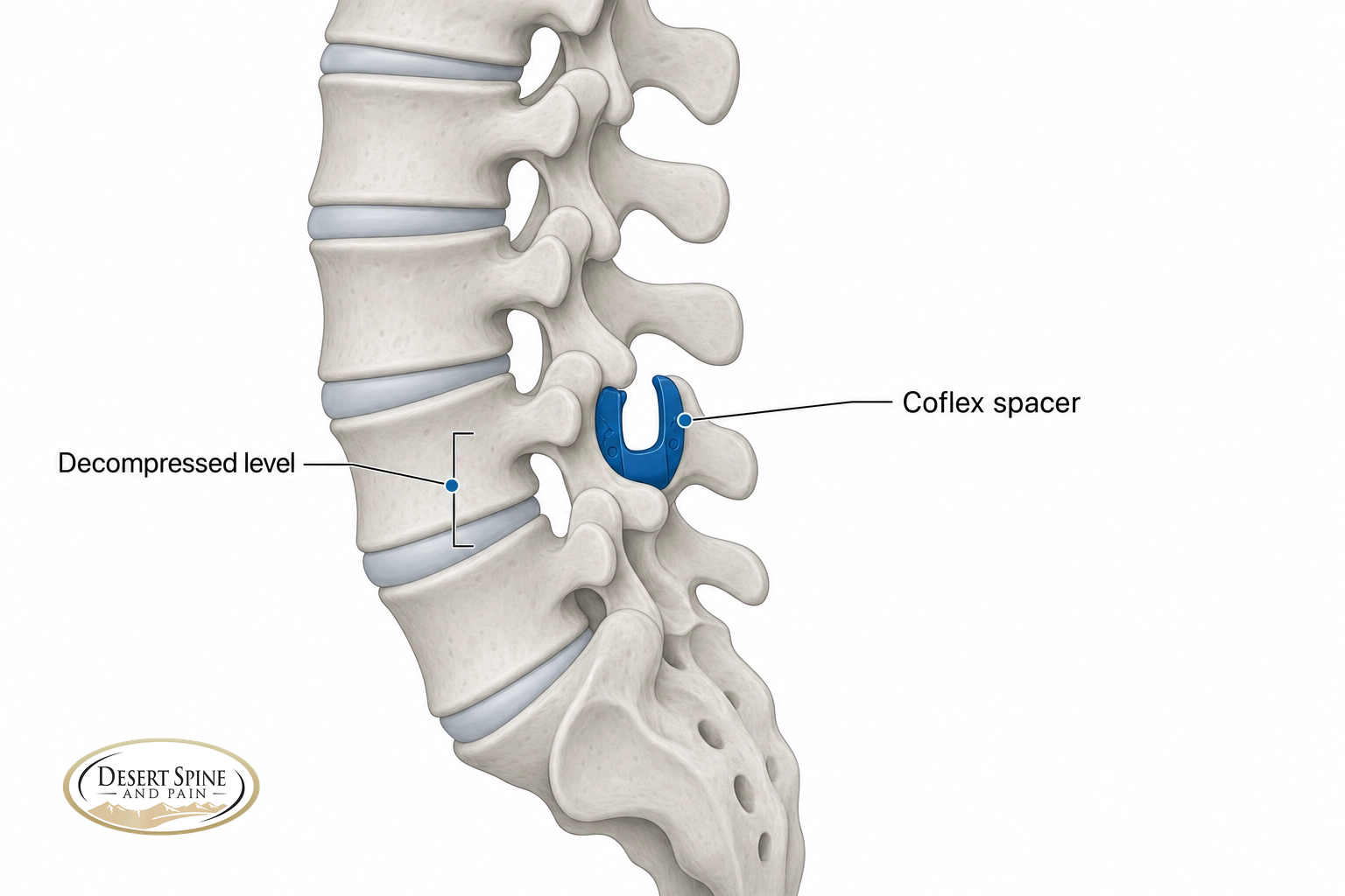 Lumbar spine diagram showing a Coflex interspinous spacer placed between the spinous processes after decompression