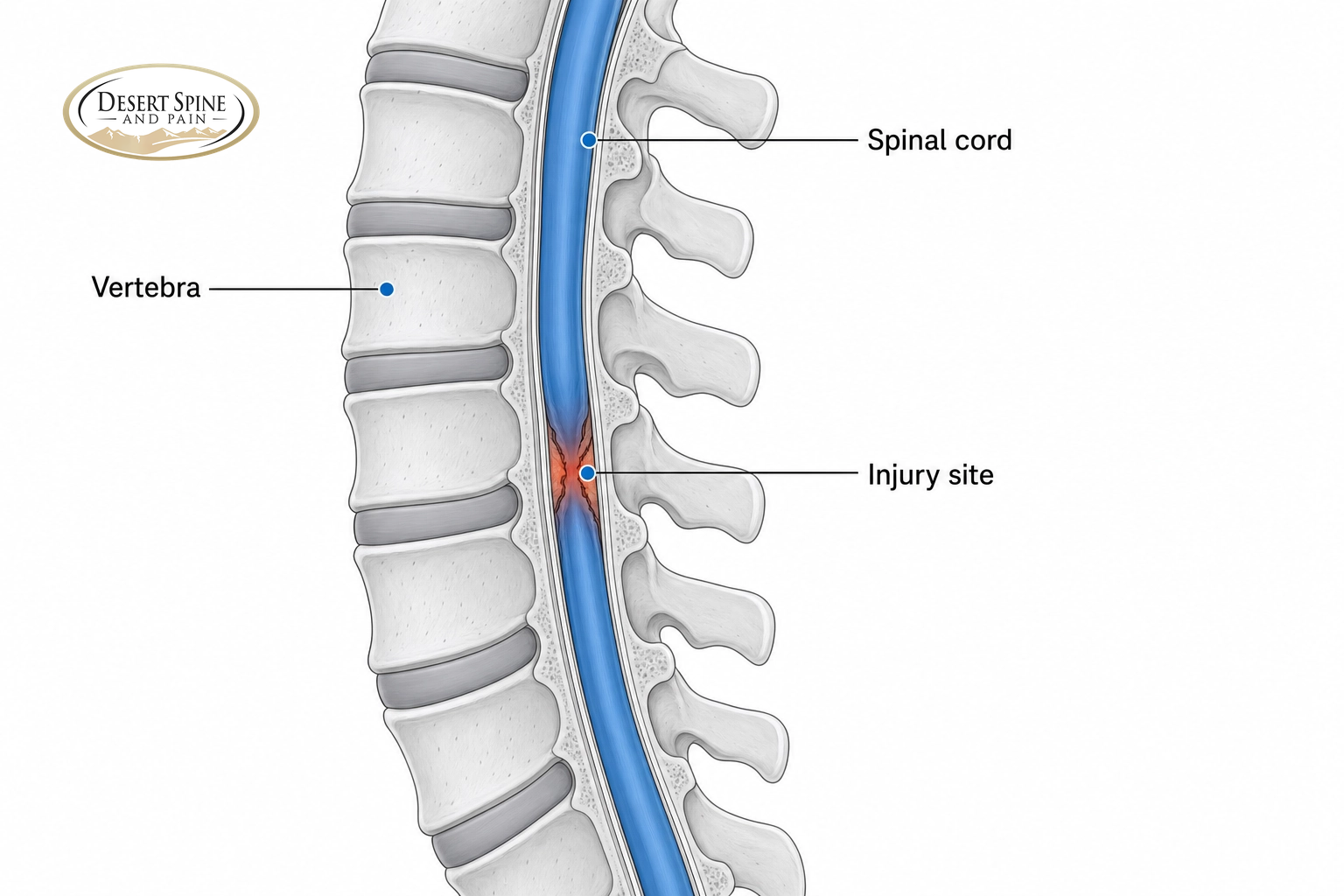Lateral spine diagram labeling a vertebra, the spinal cord, and an injury site