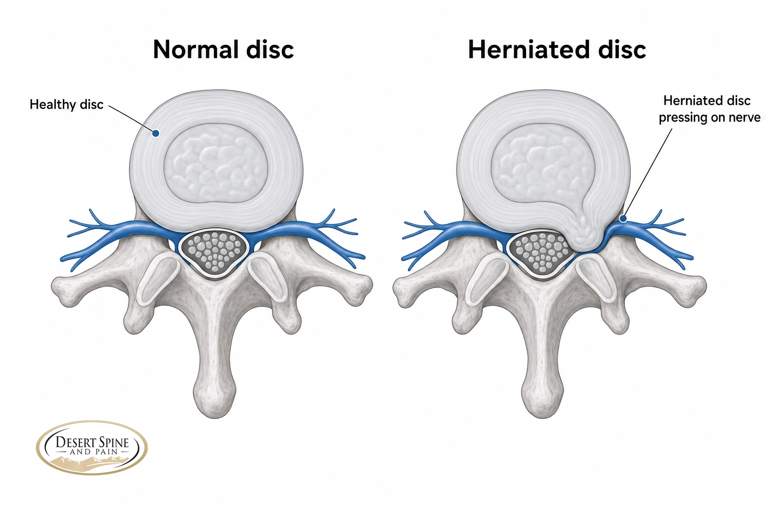 Axial cross-section comparison of a normal spinal disc versus a herniated disc pressing on a nerve root