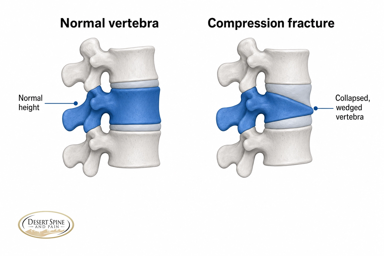 Comparison of a normal-height vertebra versus a collapsed, wedged vertebra in a compression fracture