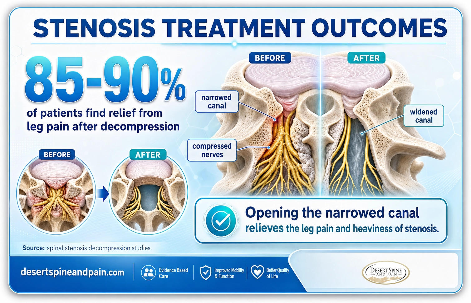 Spinal stenosis treatment: about 85 to 90 percent of patients find relief from leg pain after decompression