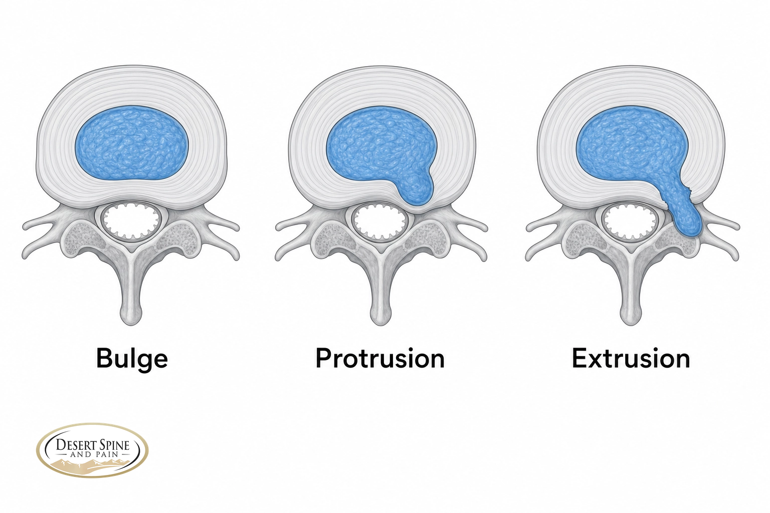 Infographic of the three stages of disc herniation: bulge, protrusion, and extrusion