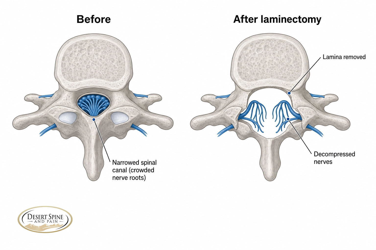 Before-and-after cross-section showing the lamina removed to open a narrowed spinal canal