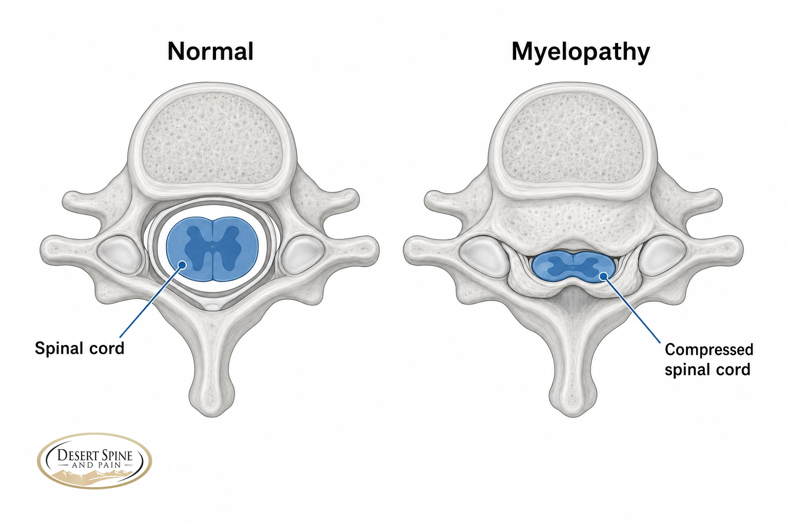 Cross-section comparison of a normal cervical spinal cord versus a compressed spinal cord in myelopathy