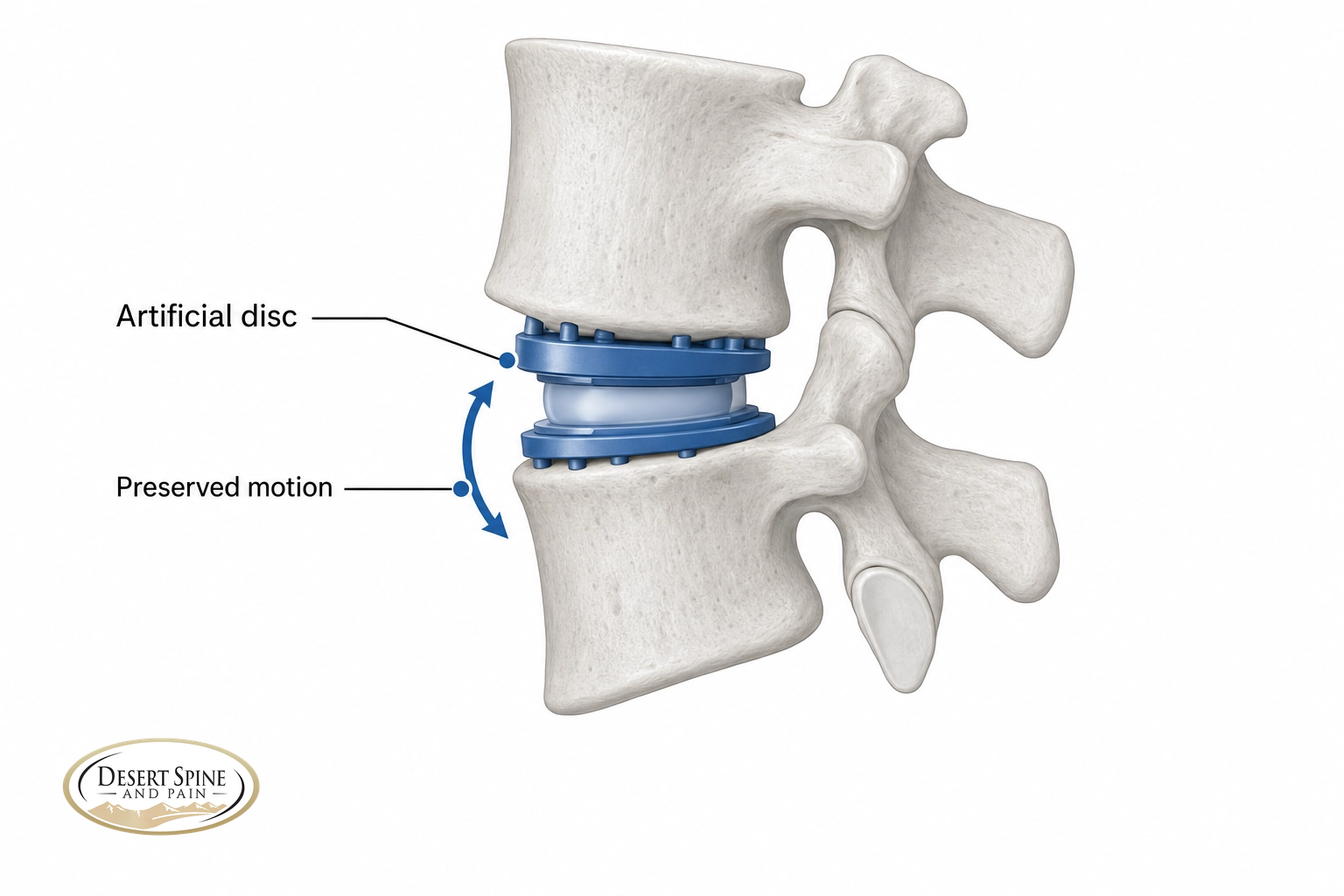 Lumbar spine diagram showing a worn disc replaced with a motion-preserving artificial disc