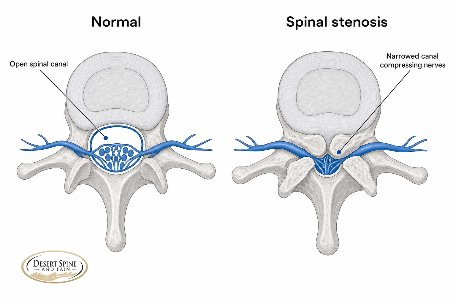 Cross-section comparison of a normal open spinal canal versus a narrowed, stenotic canal compressing the nerves