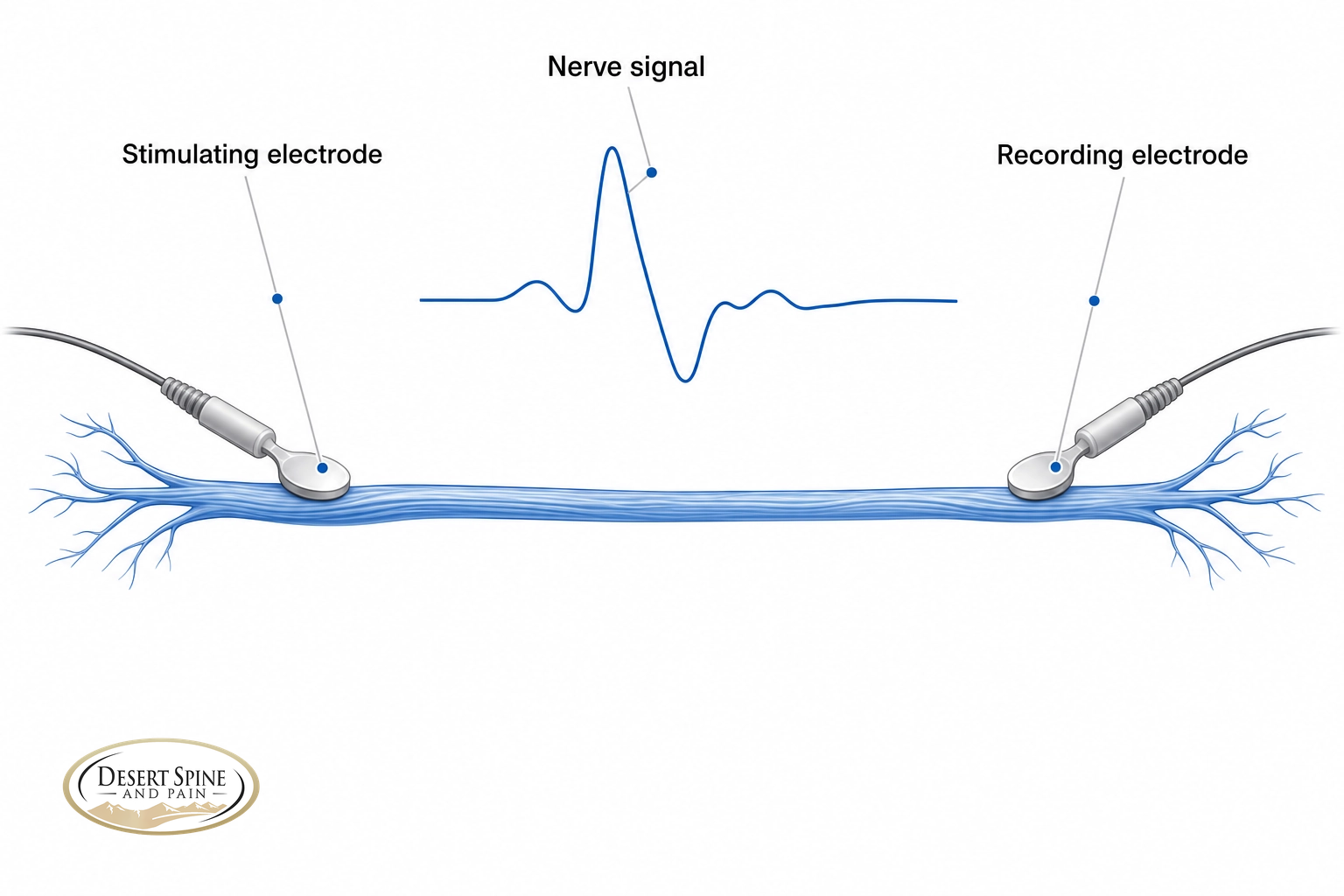 Schematic of nerve testing showing a stimulating electrode, nerve signal waveform, and recording electrode