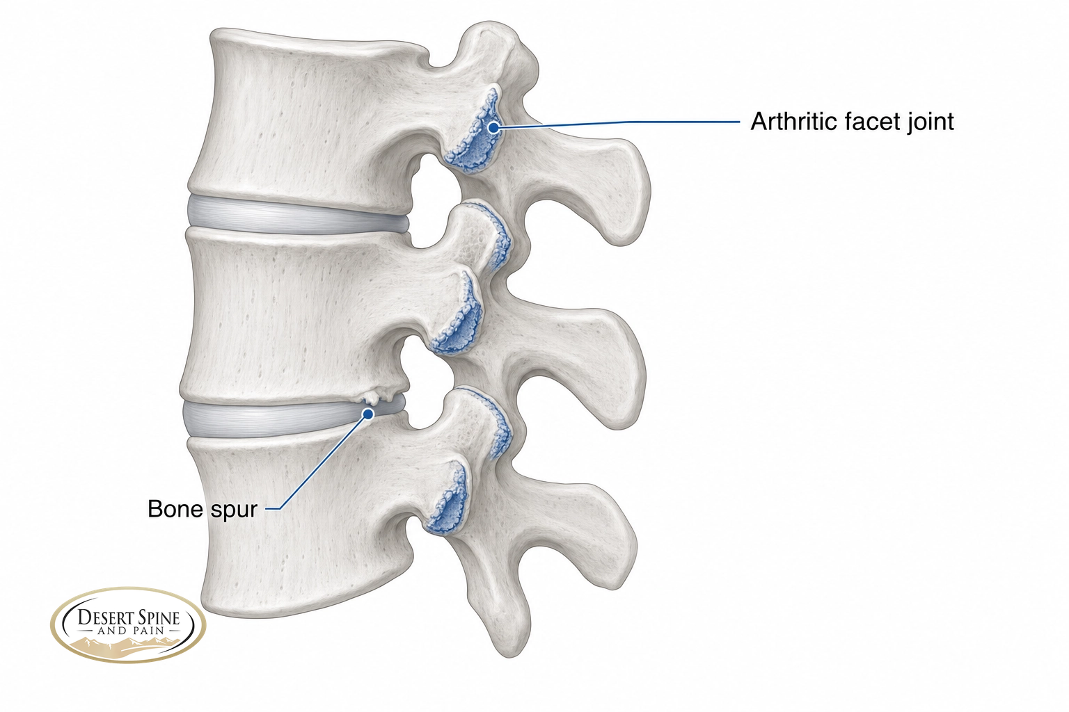 Lumbar spine diagram highlighting arthritic facet joints and a bone spur as the sites of spinal osteoarthritis