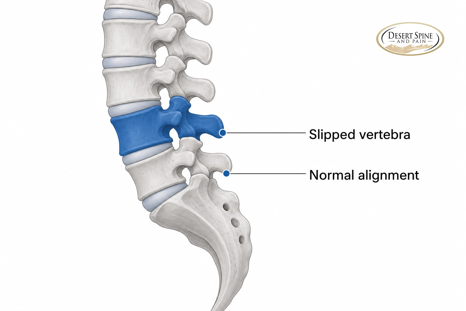 Lumbar spine diagram showing one vertebra slipped forward out of alignment over the vertebra below