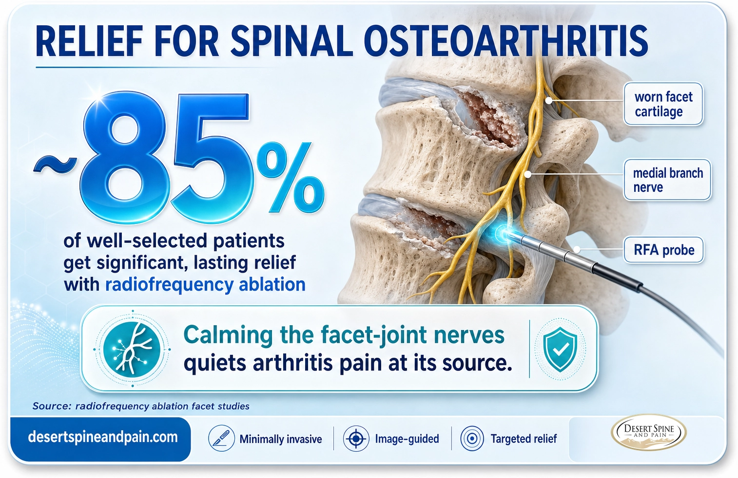 Spinal osteoarthritis: about 85 percent of well-selected patients get significant lasting relief with radiofrequency ablation