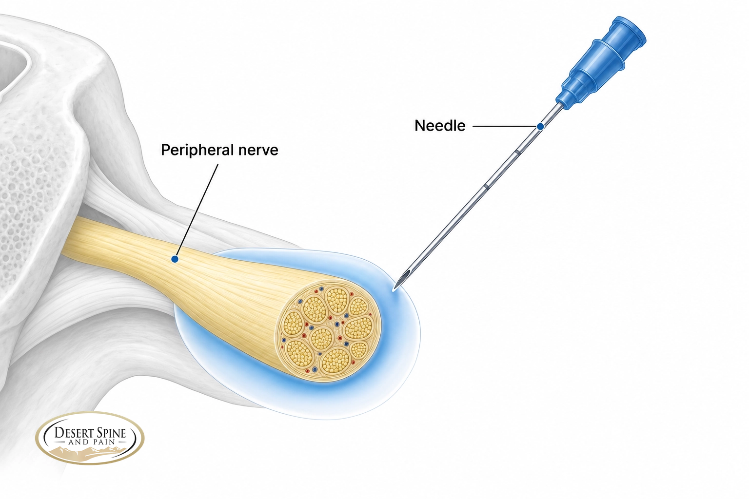 Diagram of a needle placing numbing medication around a peripheral nerve