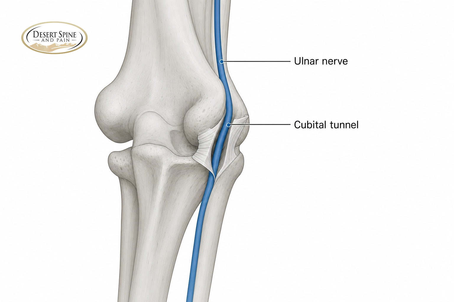 Elbow diagram showing the ulnar nerve in the cubital tunnel being decompressed
