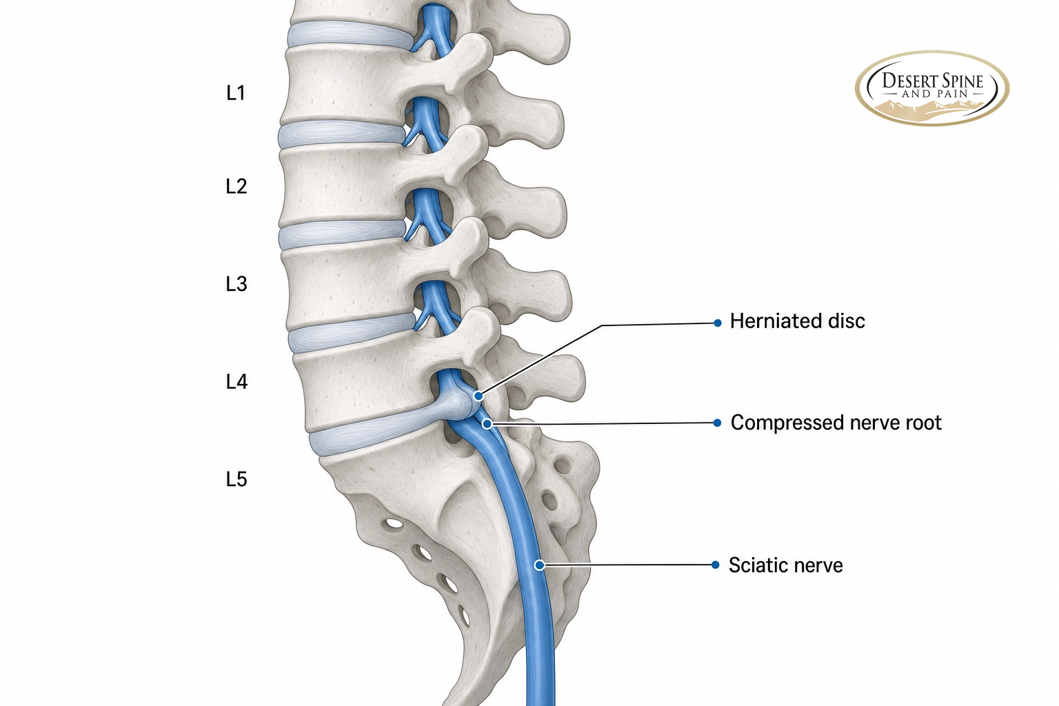 Lumbar spine diagram showing a herniated disc compressing a nerve root where the sciatic nerve begins