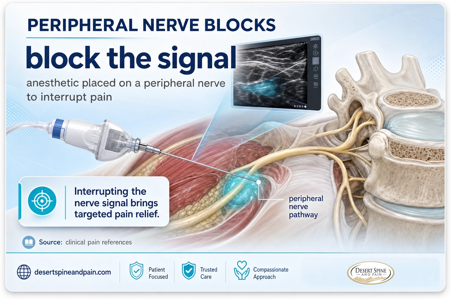 Peripheral nerve blocks: anesthetic placed on a peripheral nerve to interrupt the pain signal and bring targeted relief