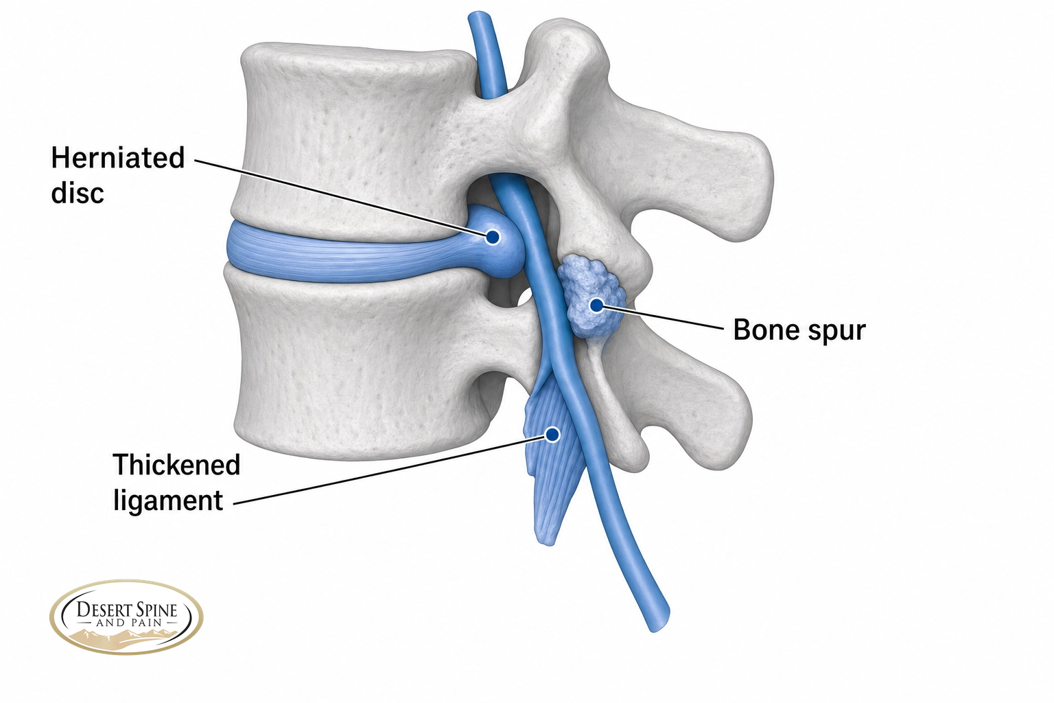 Diagram of a spinal nerve compressed by a herniated disc, a bone spur, and a thickened ligament