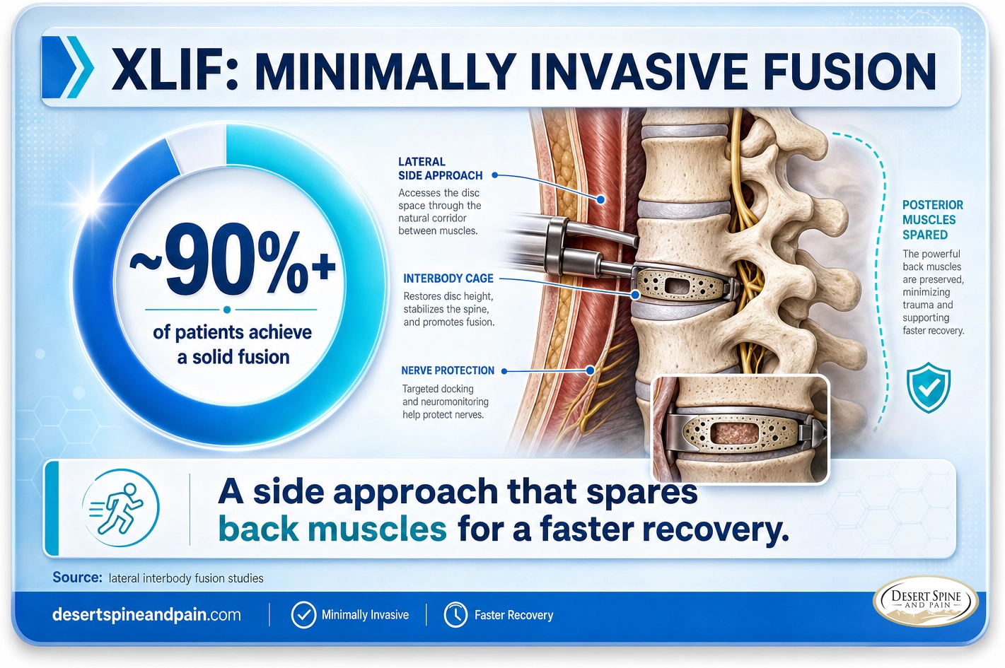 XLIF: about 90 percent or more achieve a solid fusion through a muscle-sparing side approach