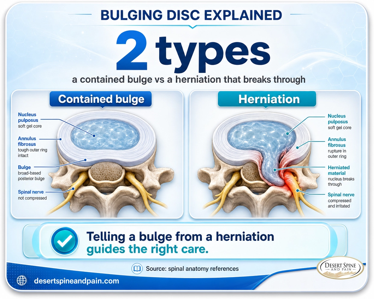 Bulging disc: a contained bulge versus a herniation that breaks through and presses on a nerve