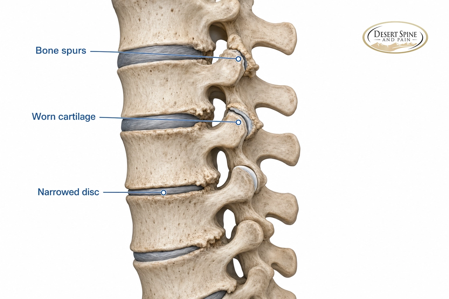 Diagram of a spine segment labeling bone spurs, worn cartilage and a narrowed disc from degenerative arthritis