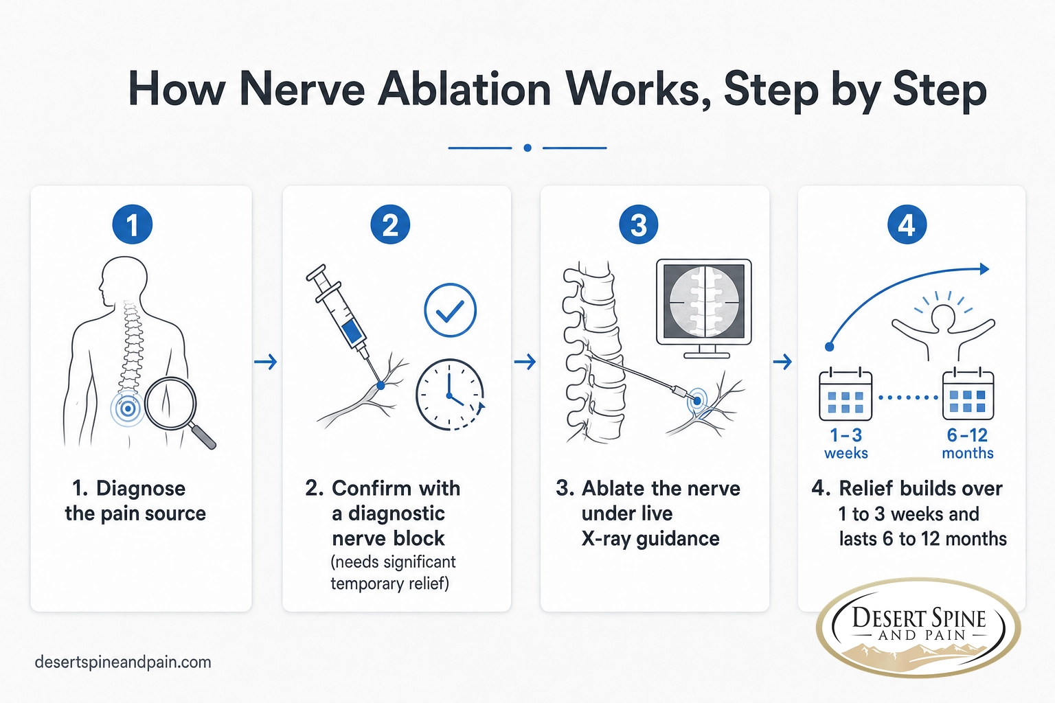 Four-step infographic of the nerve ablation process from diagnosis to lasting relief of 6 to 12 months