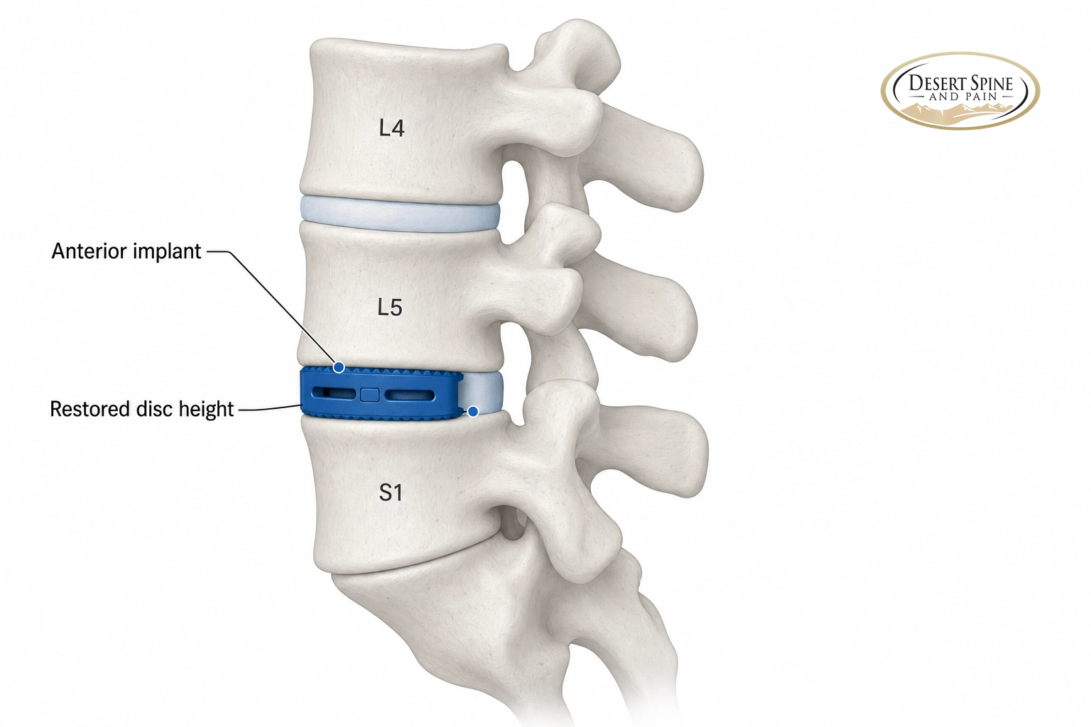 Lumbar spine diagram showing an anterior interbody implant that restores disc height