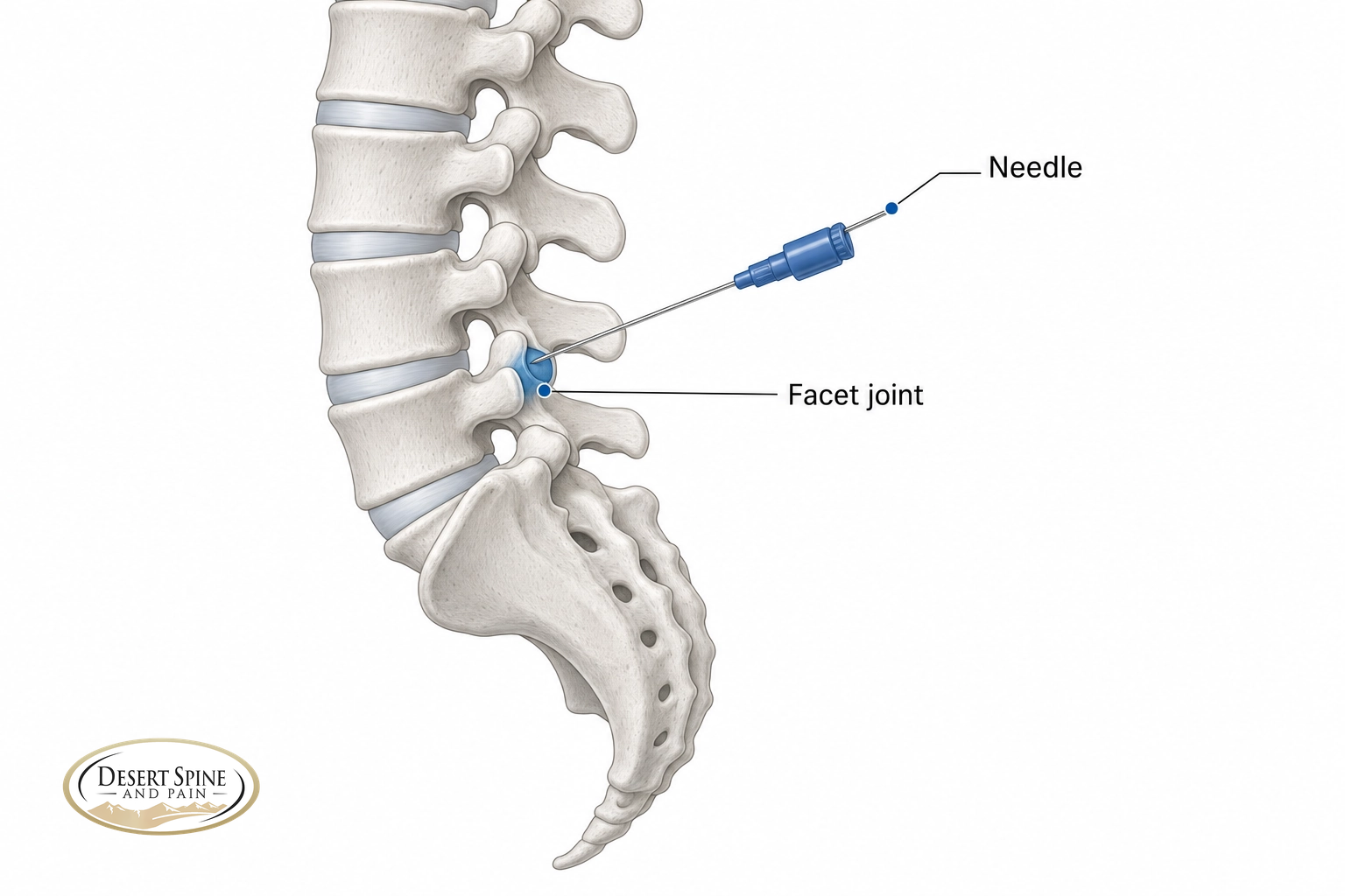 Lumbar spine diagram showing a needle entering a posterior facet joint