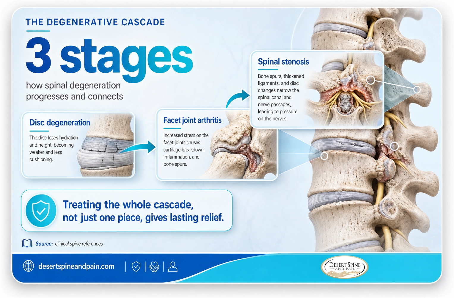 Degenerative arthritic cascade: disc degeneration leads to facet joint arthritis and then spinal stenosis
