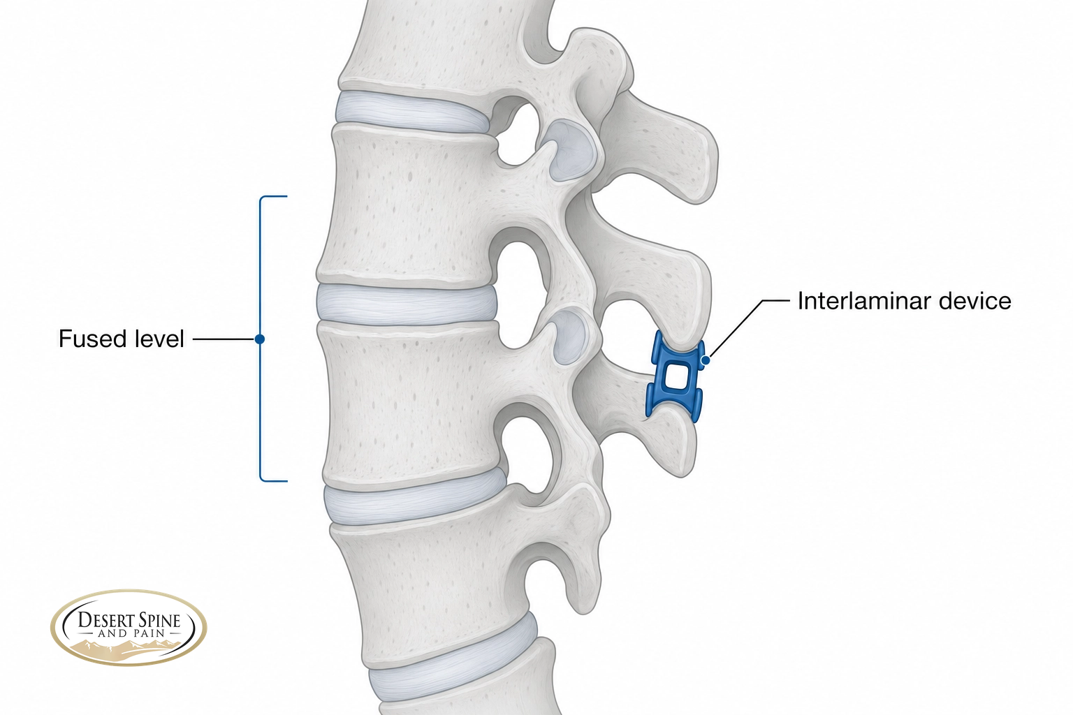 Lumbar spine diagram showing an interlaminar fixation device between the spinous processes