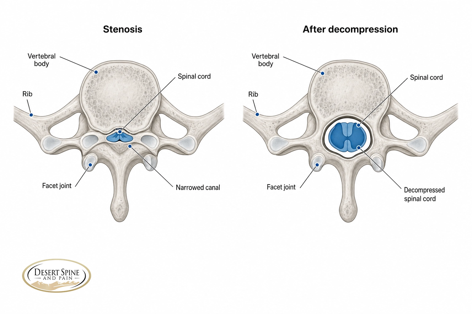 Before-and-after cross-section of a thoracic spinal canal decompressed to relieve cord compression