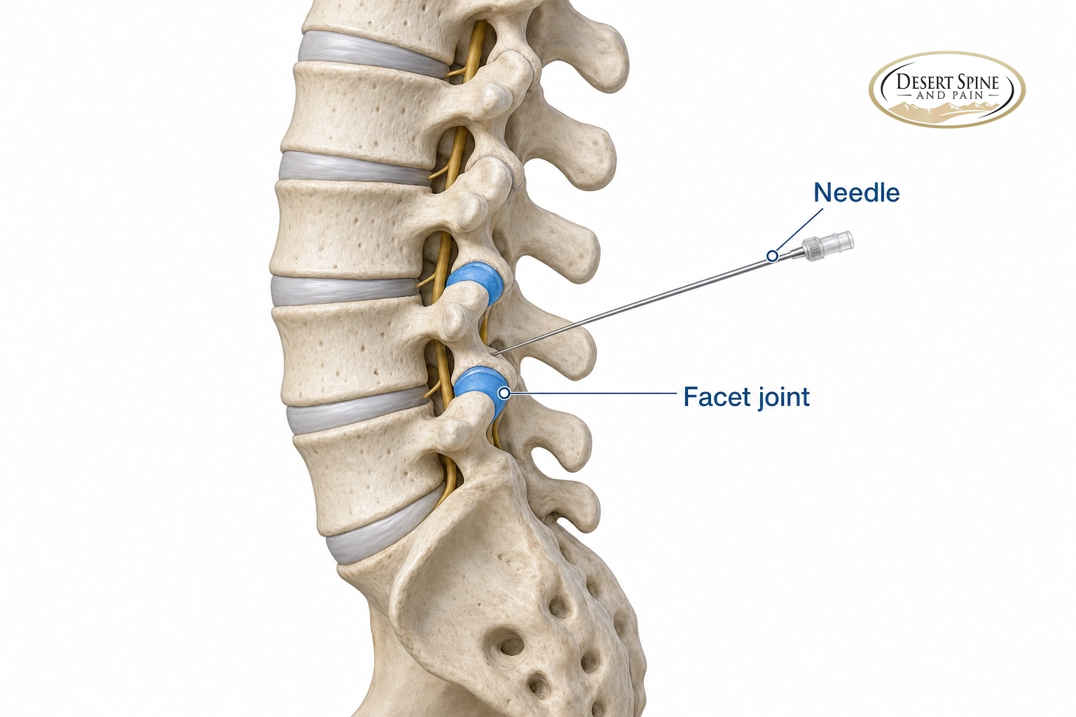 Diagram of an image-guided spinal injection with a needle targeting a facet joint
