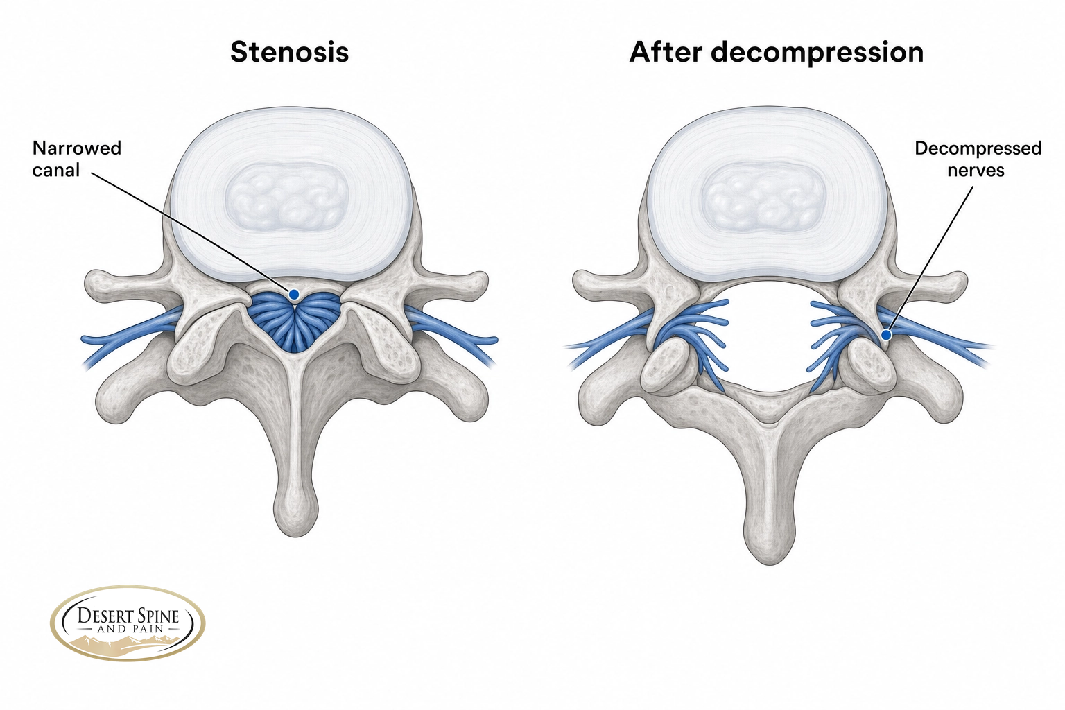Before-and-after cross-section of a lumbar spinal canal decompressed to relieve stenosis
