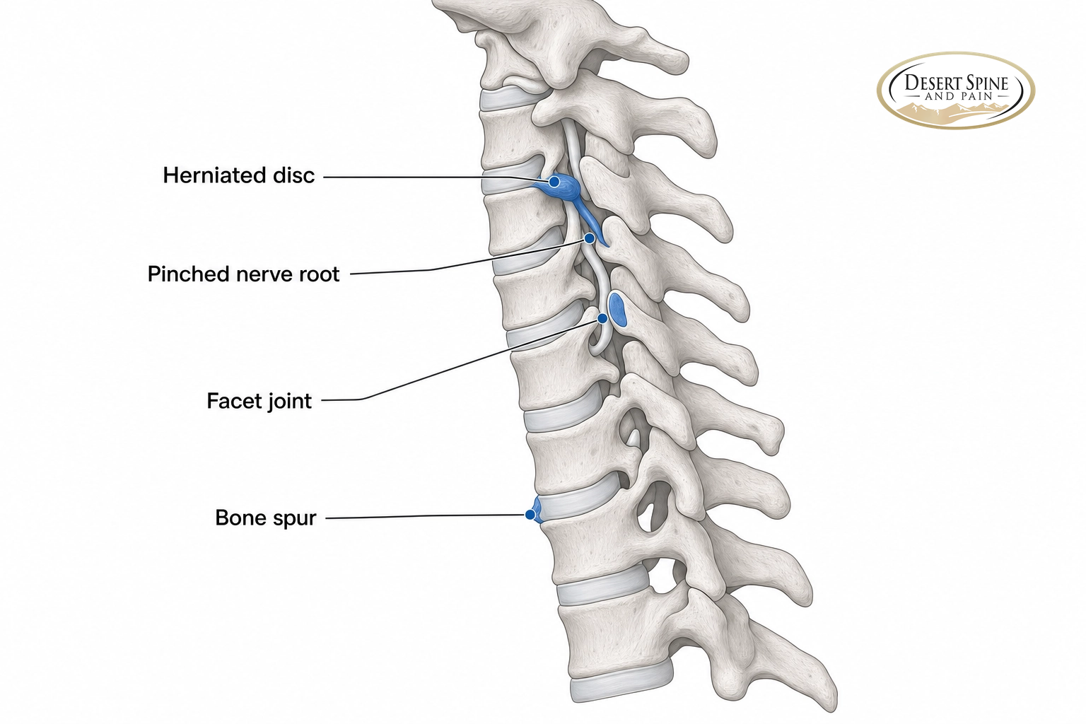 Cervical spine diagram labeling a herniated disc, facet joint, pinched nerve root, and bone spur as common sources of neck pain