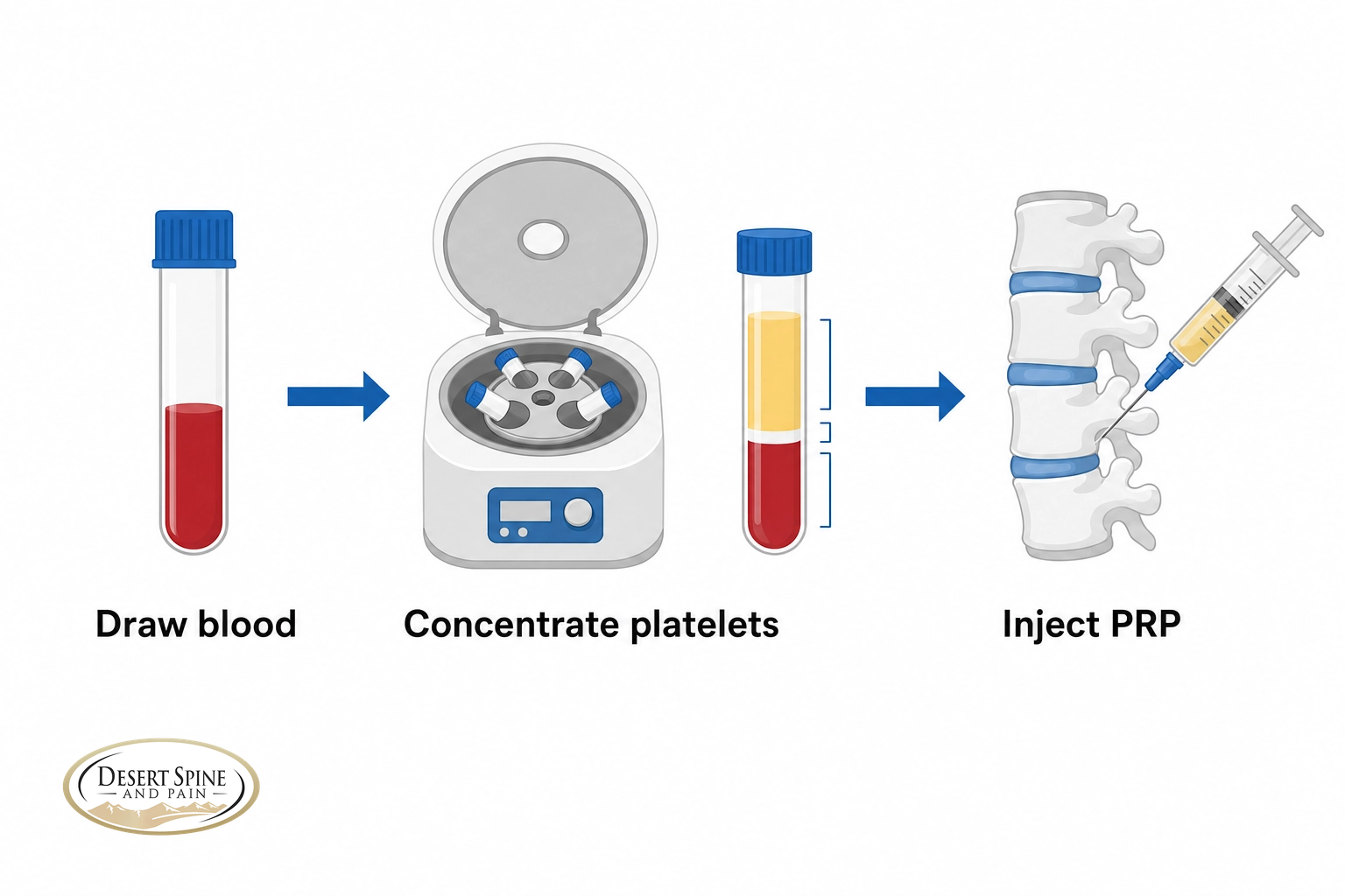 Three-step infographic of PRP therapy: draw blood, concentrate platelets, and inject PRP
