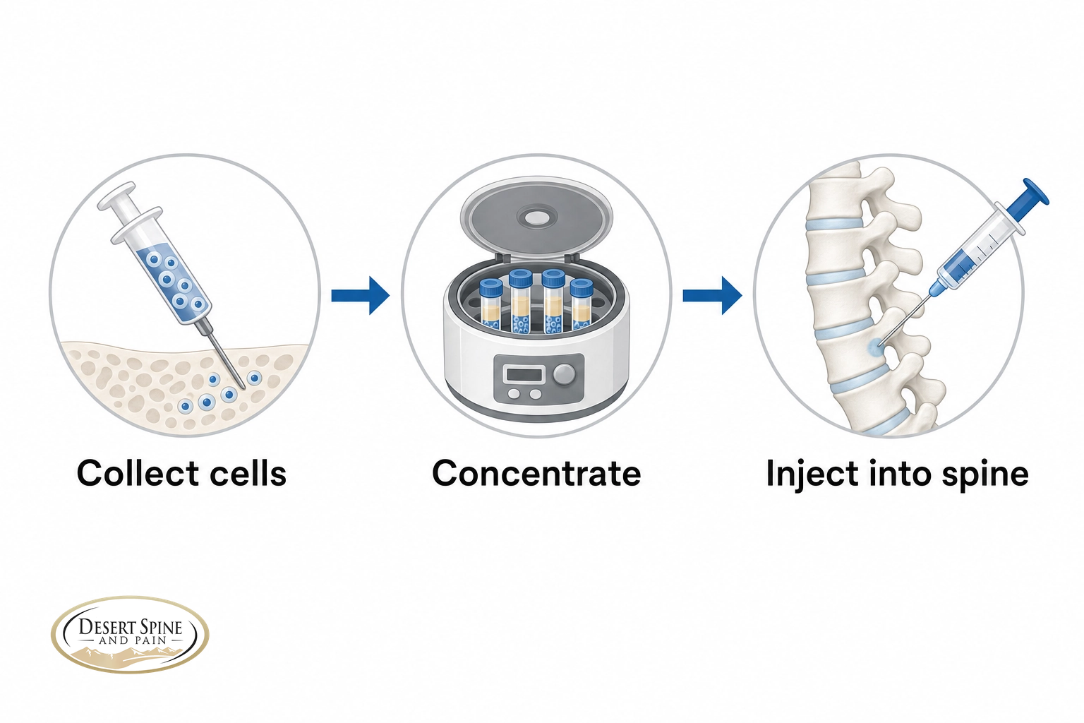 Three-step infographic of stem cell therapy: collect cells, concentrate, and inject into the spine