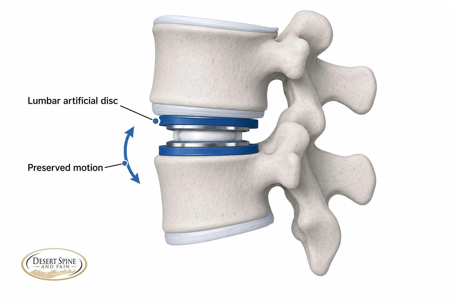 Lumbar spine diagram showing a worn disc replaced with a motion-preserving lumbar artificial disc