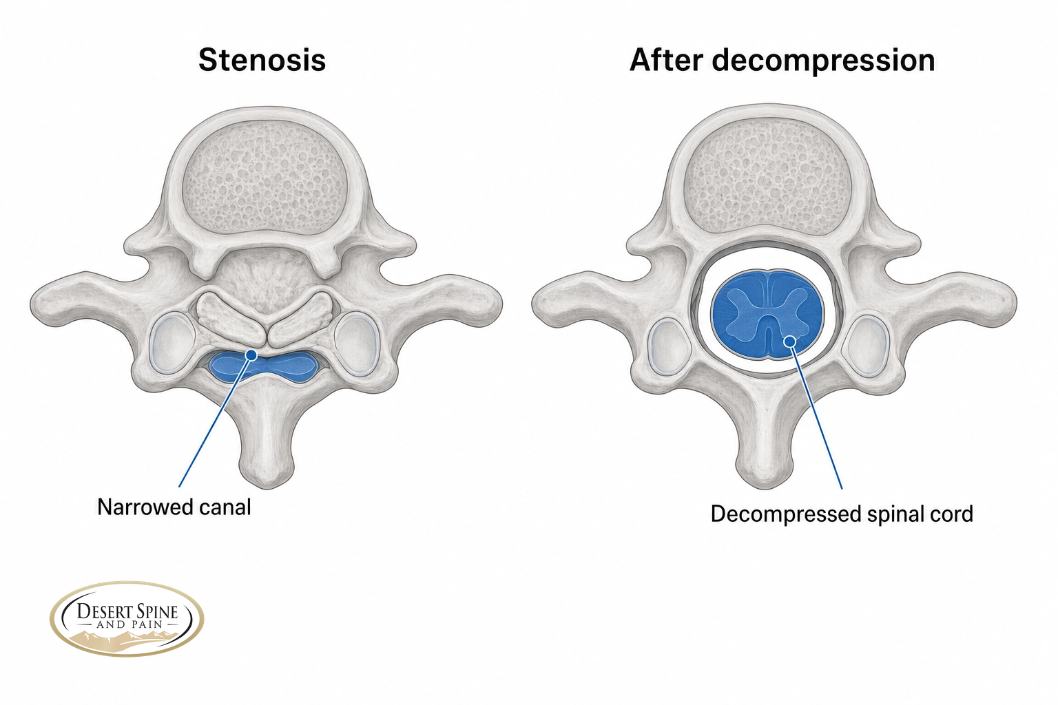 Before-and-after cross-section of a cervical spinal canal decompressed to relieve spinal cord compression
