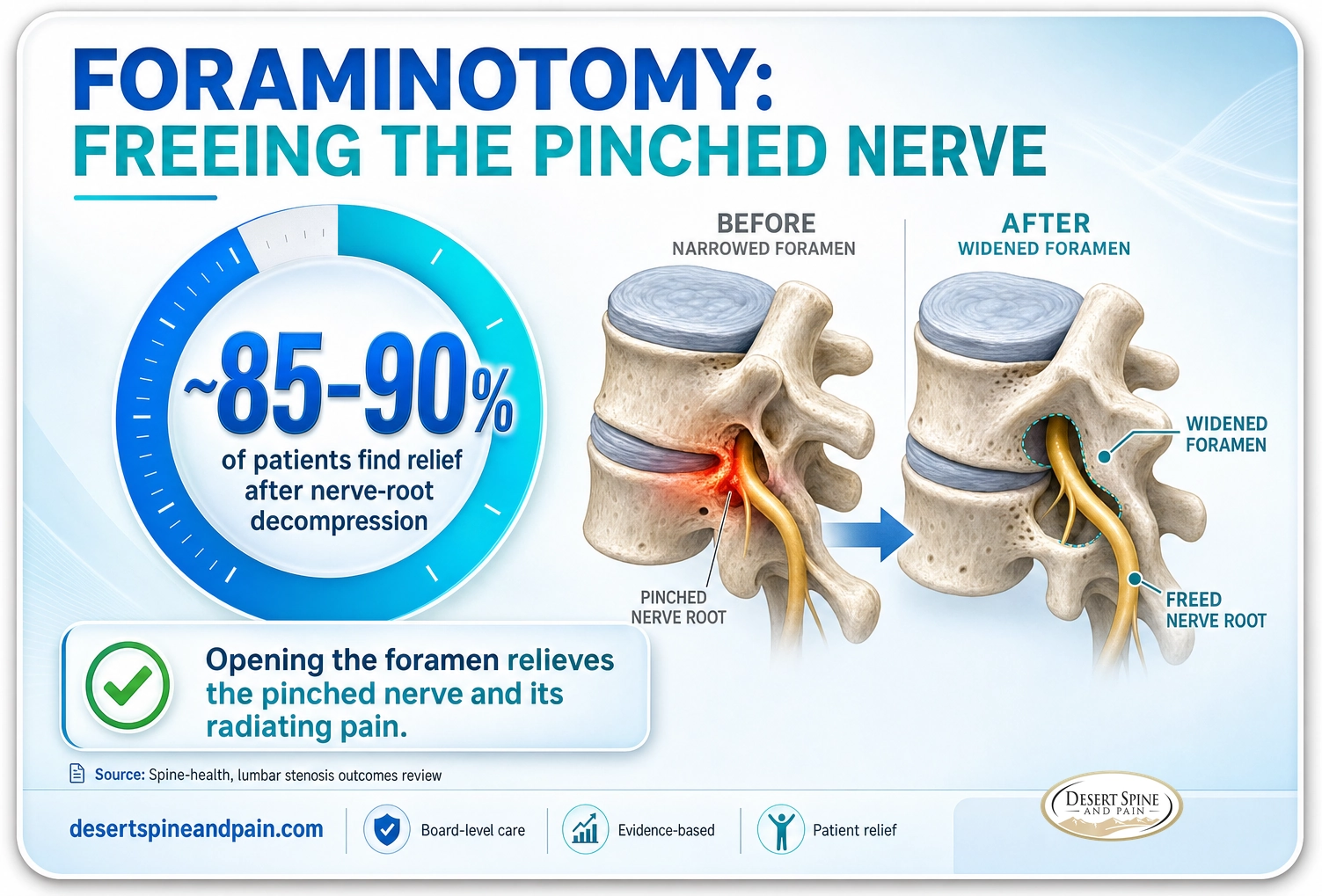 Foraminotomy: about 85 to 90 percent of patients find relief after nerve-root decompression