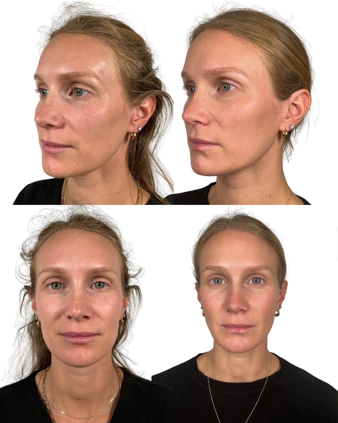 A Piqûre patient before and after treatment with Radiesse