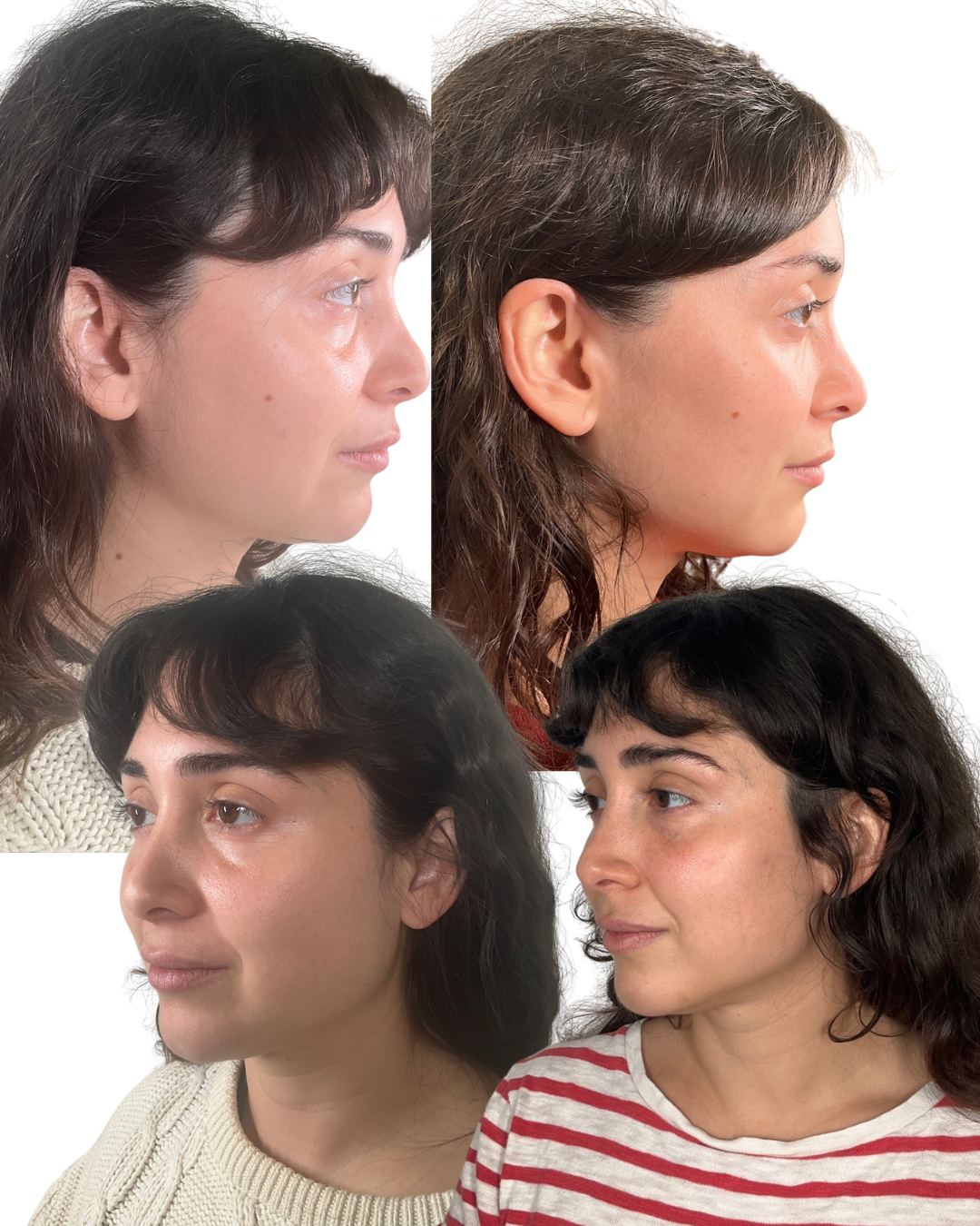 Two Piqûre patients before and after Radiesse combined with other treatments