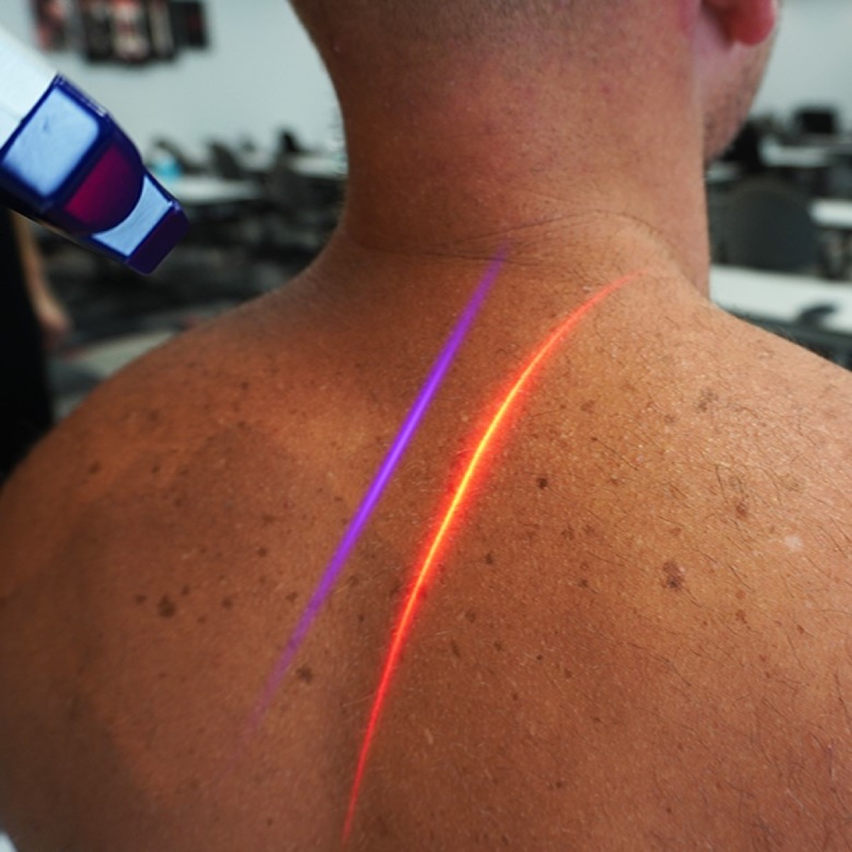 The Erchonia EVRL cold laser tracing painless red and violet light across a patient's upper back