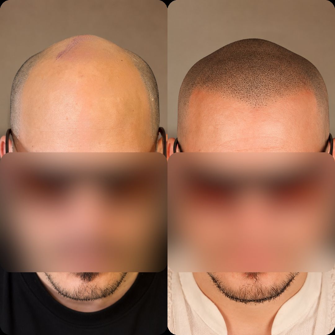 Caso real de micropigmentación capilar — recuperación de densidad