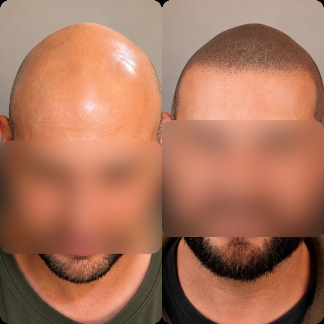 Caso real de micropigmentación capilar — coronilla