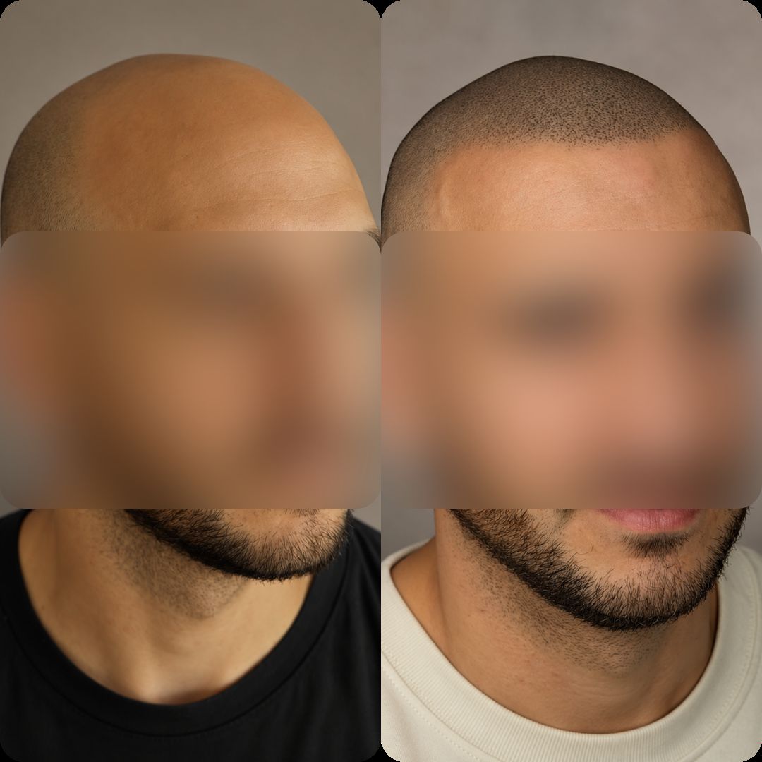 Caso real de micropigmentación capilar — recuperación de entradas