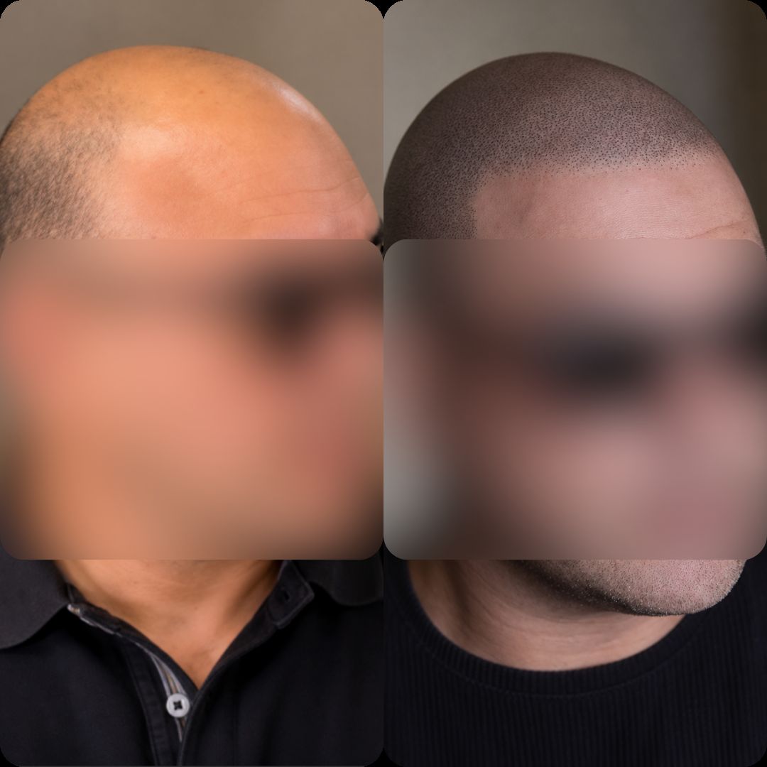 Caso real de micropigmentación capilar — look rapado