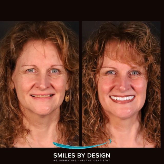 Smile Makeover Snap on Denture