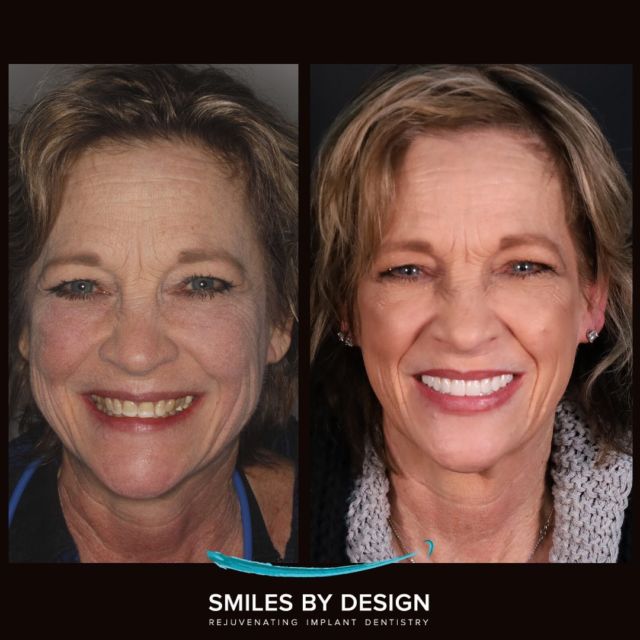 Smile Makeover Implant Denture