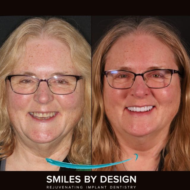 Smile Makeover All on Four