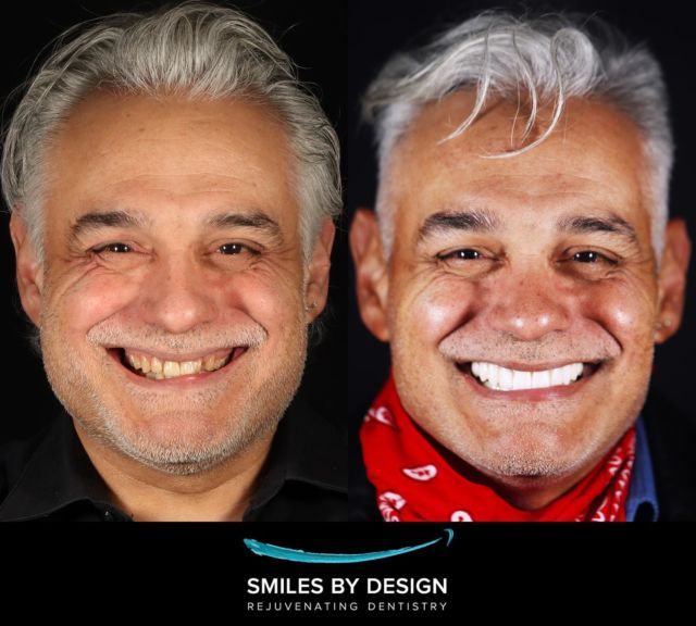 Smile Makeover Permanent Denture
